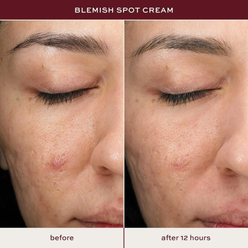 ITK Skincare Salicylic Acid Acne Spot Treatment for Face, Back & Body - Fast Active Acne Relief - Pimple Cream for Acne Prone Skin - Clear Blemishes Fast with Tea Tree Oil - 0.5oz - Image 4