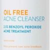 acne treatment